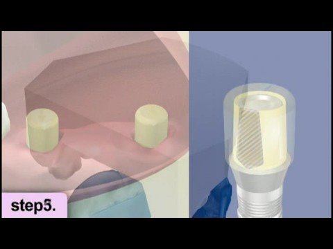 Dental Implant Procedure Video